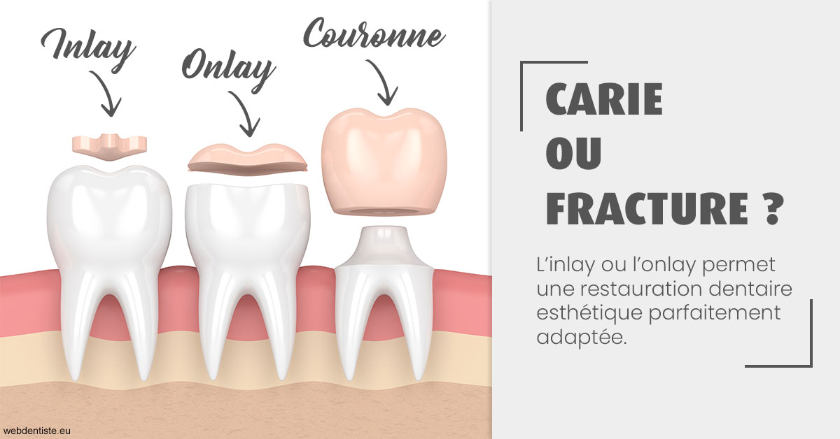 https://www.cabinetcipriani.fr/T2 2023 - Carie ou fracture 1