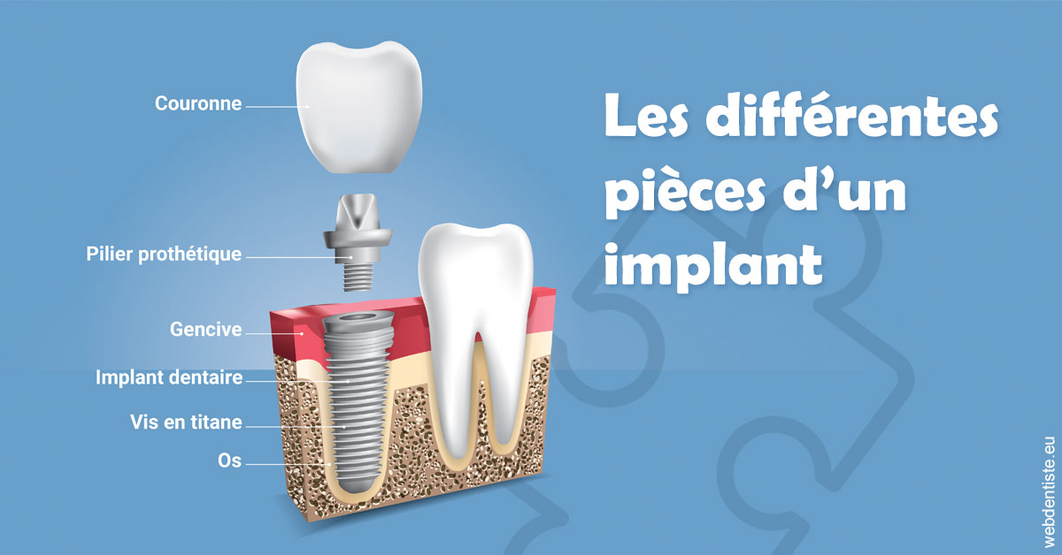 https://www.cabinetcipriani.fr/Les différentes pièces d’un implant 1